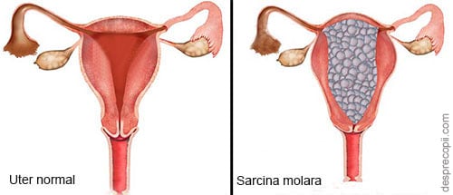 Sarcina molara